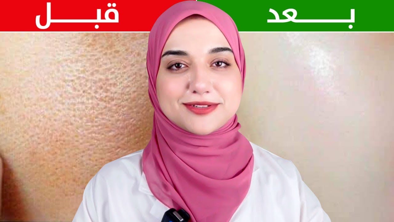 وصفة سريعة لتضييق المسام الواسعة و التخلص منها للأبد ..
