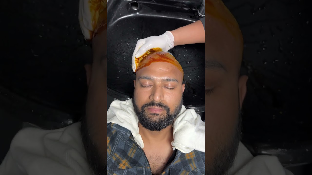 Best Hair Transplant Surgery | Latest Fue Technique #shorts #viral #hair transplant