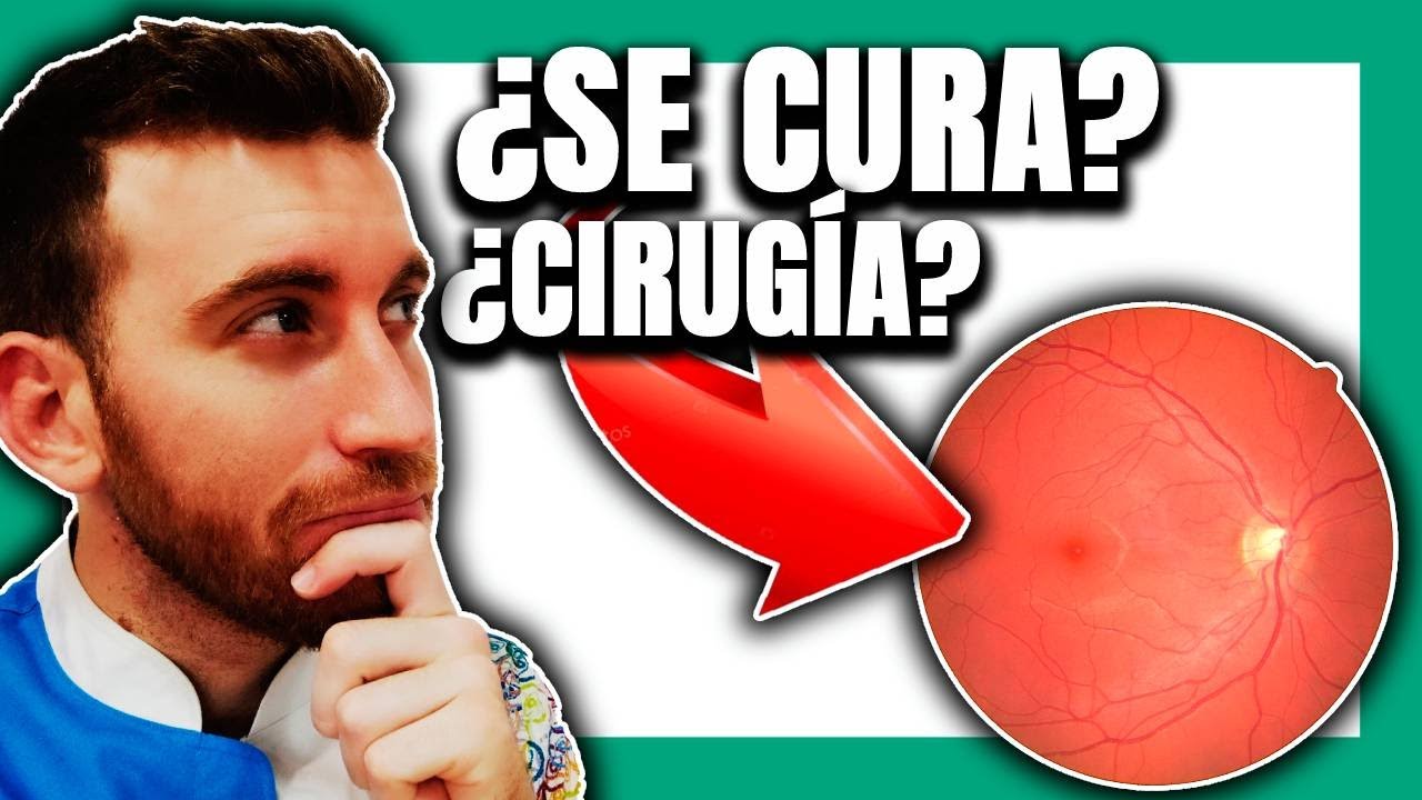 🟢 ¿Curar el GLAUCOMA? ¿Cómo se trata? #3