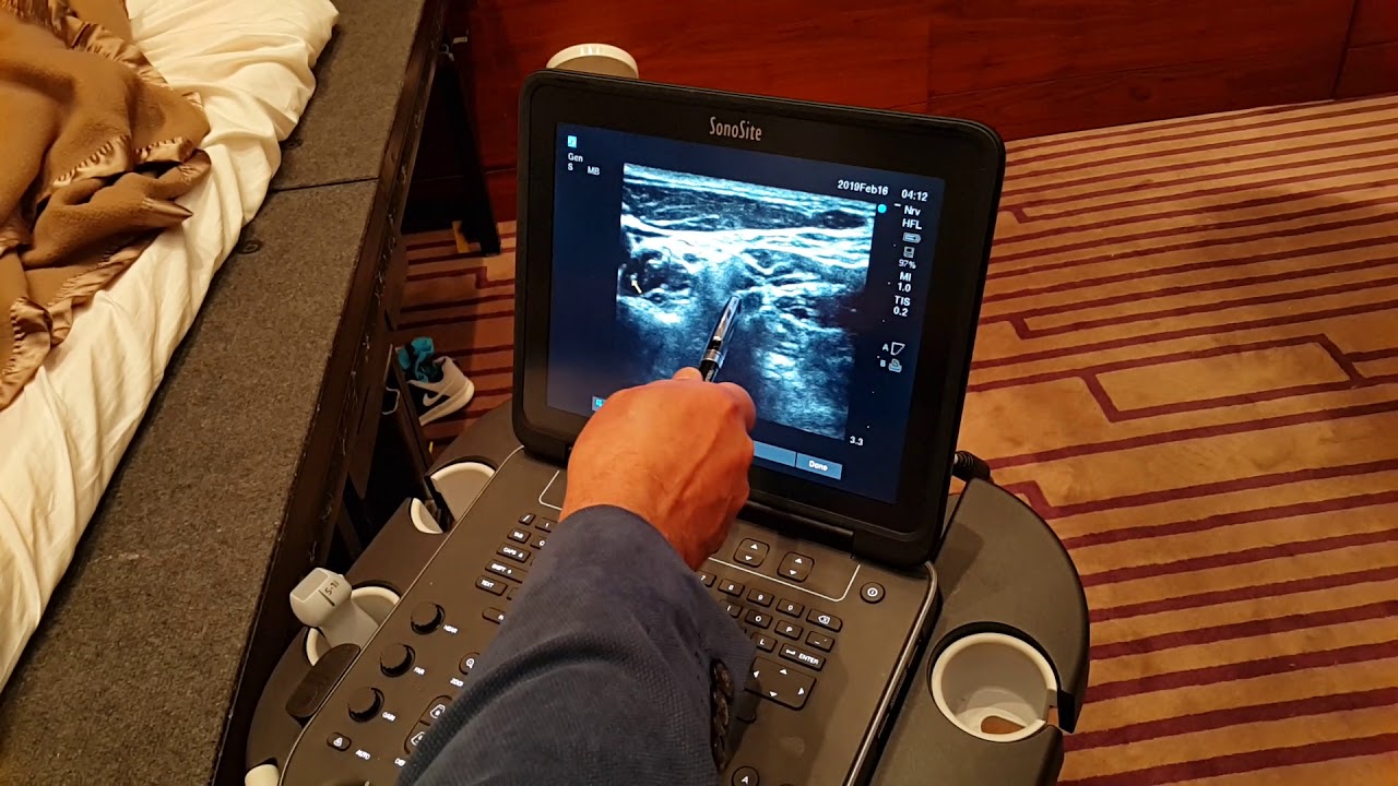 Ultrasound guided stellate ganglion block by Rafael Blanco at JCRAC19