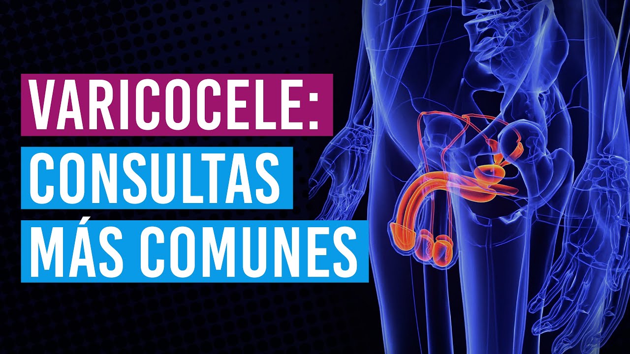 Dudas más comunes sobre el varicocele en consulta 👨‍⚕️