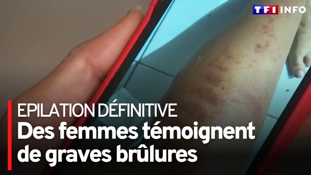 Epilation définitive : des femmes témoignent de graves brûlures
