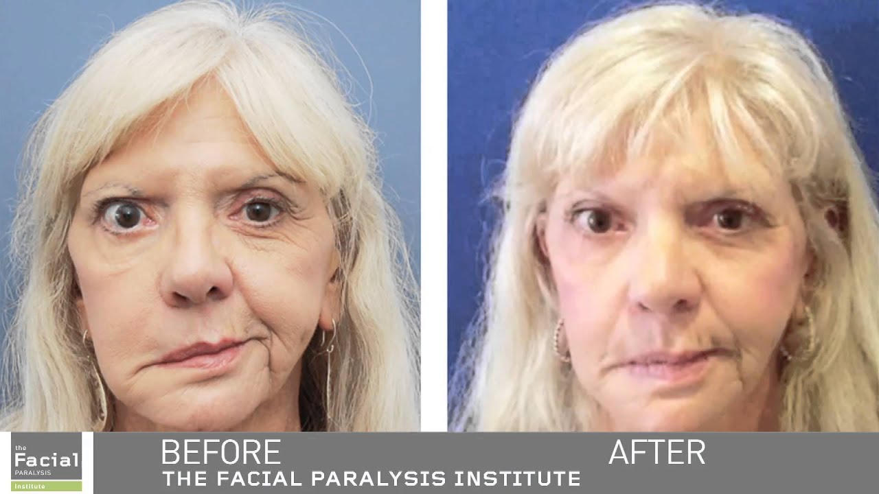Facial Paralysis Surgery | Before & After | Babak Azizzadeh, MD, FACS