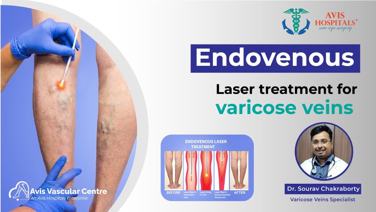 Endovenous laser treatment for varicose veins | Dr Sourav Chakraborty