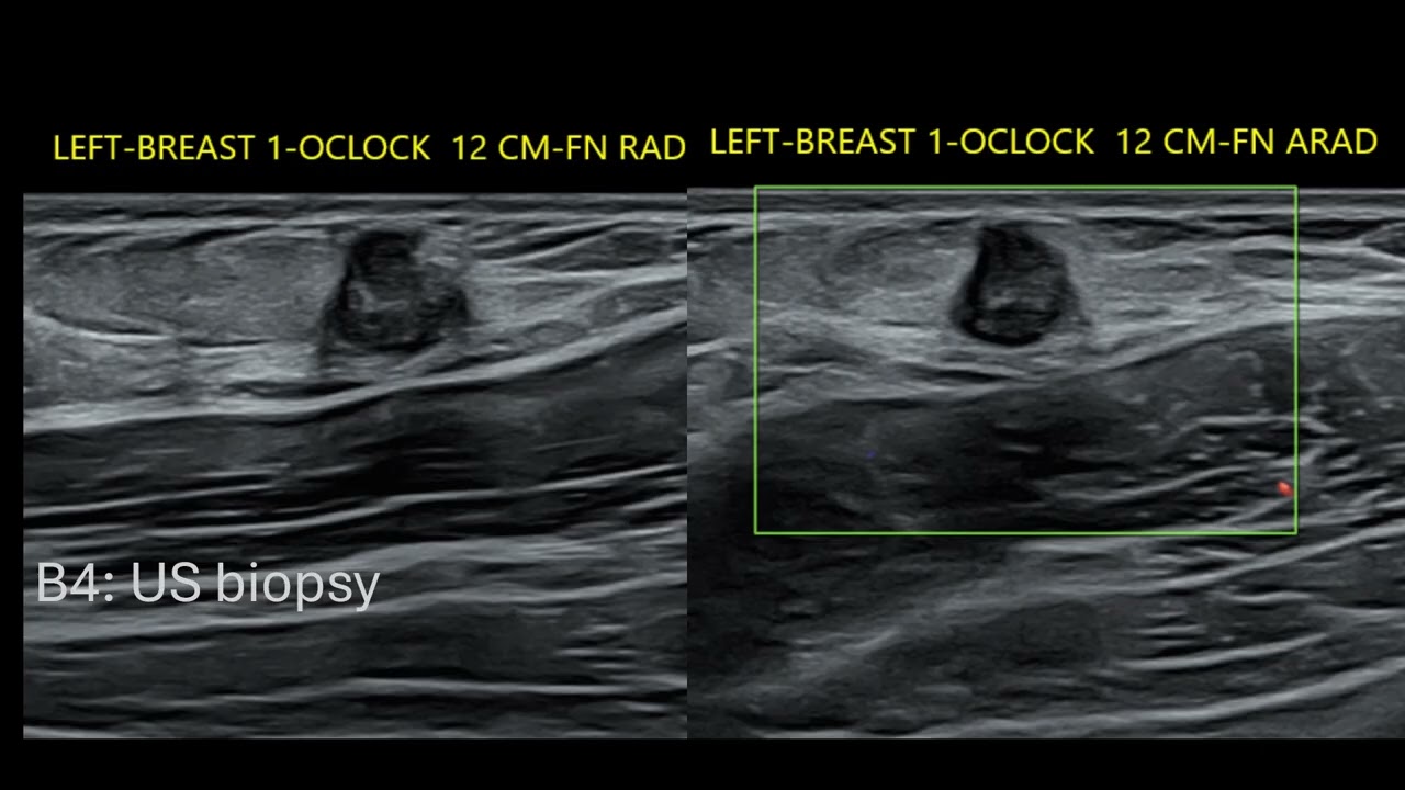 Pediatric Breast Case Review | Free Radiology CME