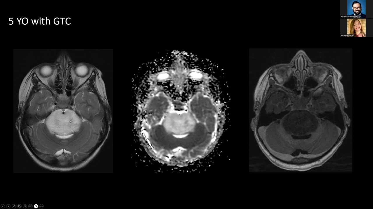 Pediatric Bran Tumors: What's New --  Dr.  Vanessa Rameh --   4.11.2024