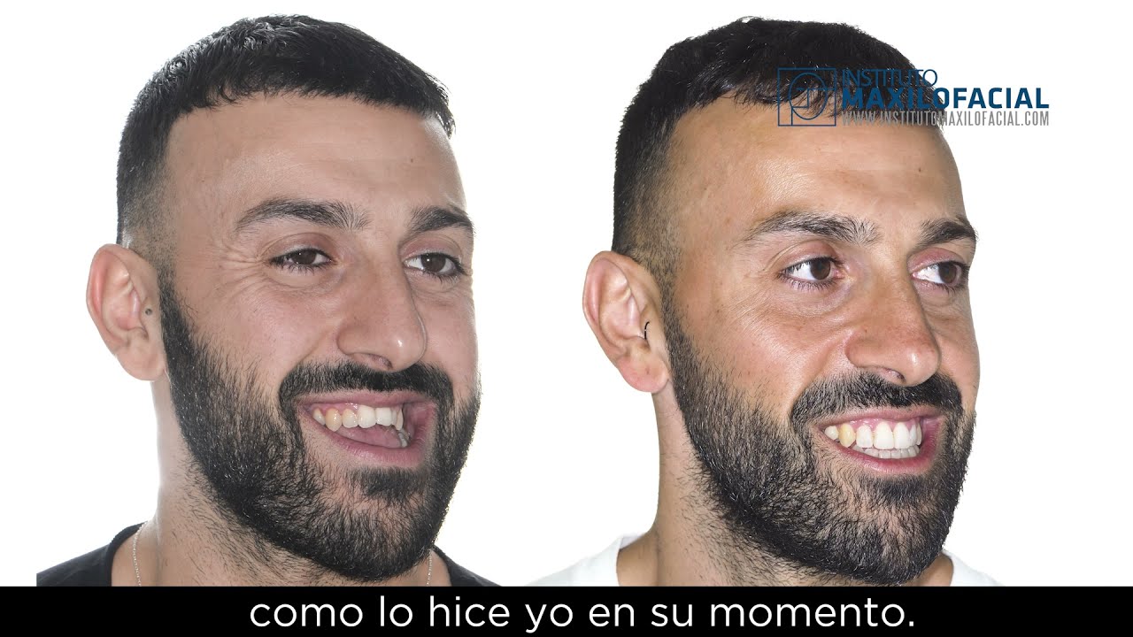 Cirugía ortofacial. Caso # 86: Giuseppe - Clase III, asimetría facial, mordida abierta