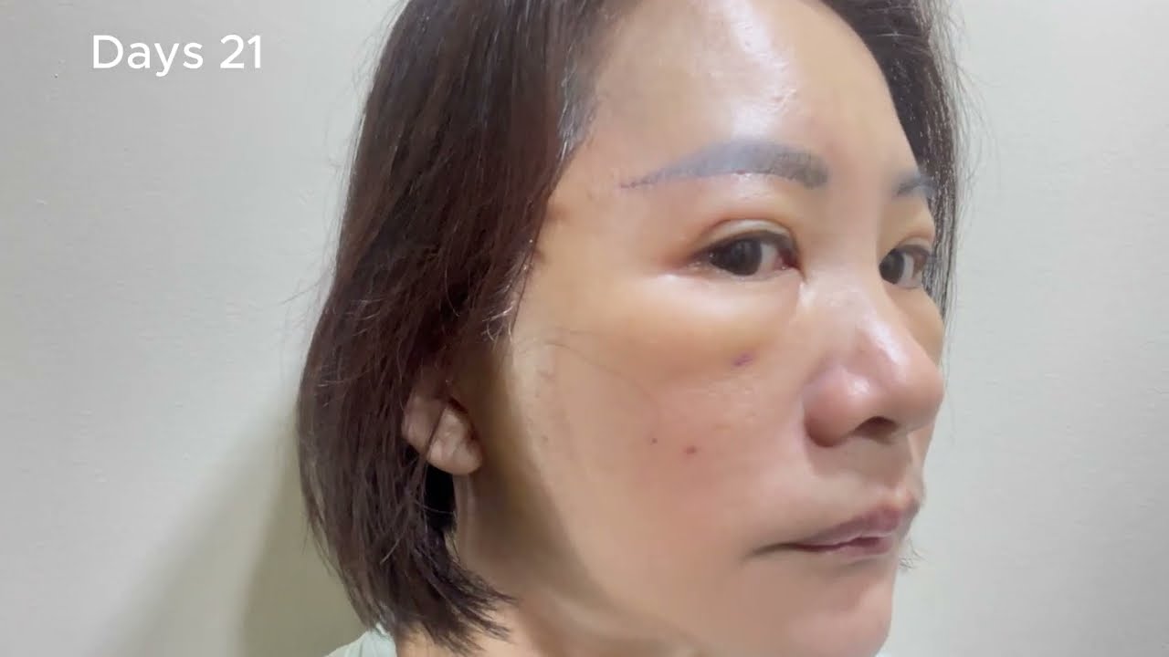 Days 21 to 25 | Facelift Healing Days | How I’m Really Feeling