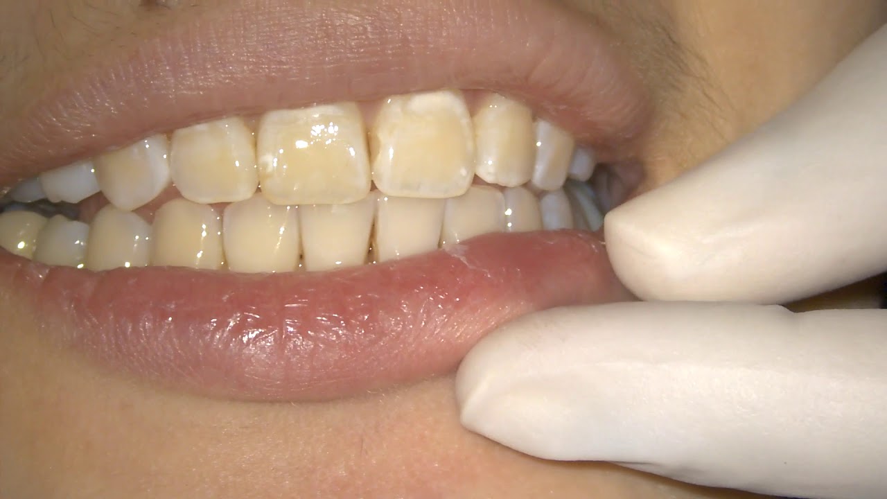 [Periodontal Examination Series] 1. Attached Gingiva Assessment - Tension Test & Roll Test