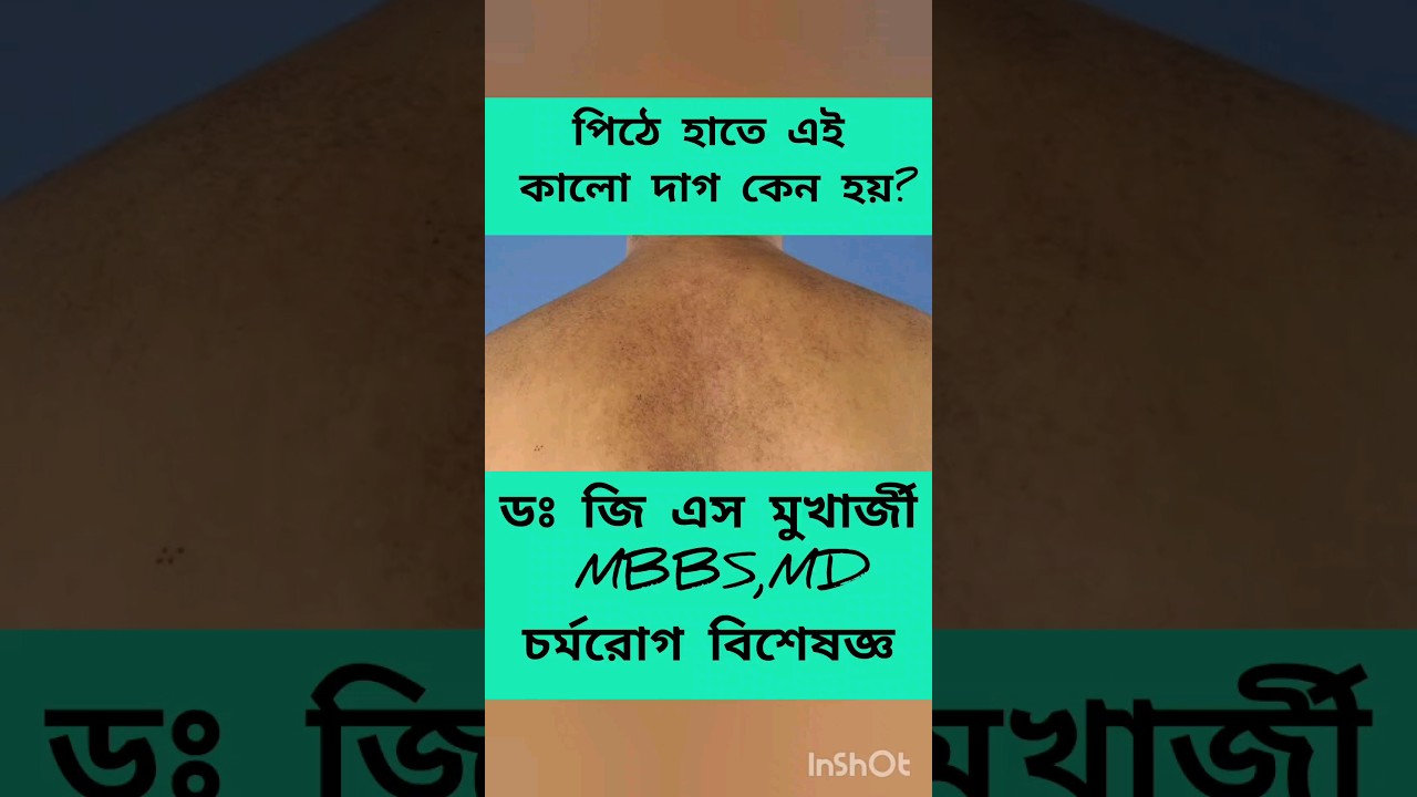 পিঠে হাতে কালো দাগ কেন হয়? #pigmentation #skinspecialist #dermatologist