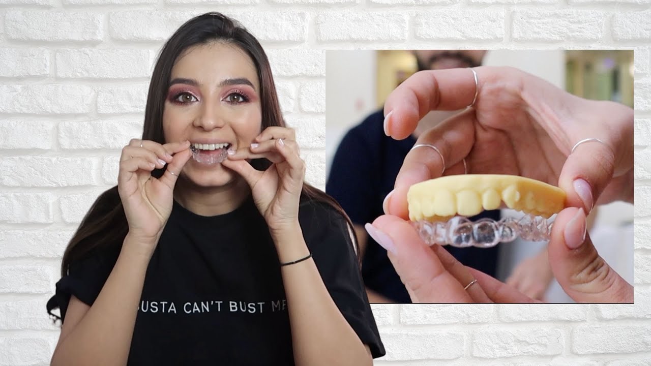 MI-AM PUS APARAT DENTAR INVIZIBIL - tot ce trebuie sa stii
