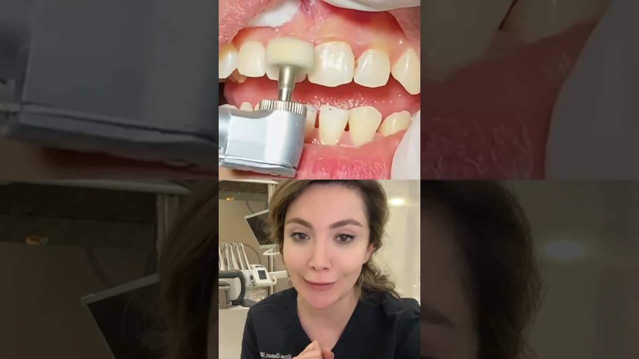 Can Dental Fillings Change Their Color?!