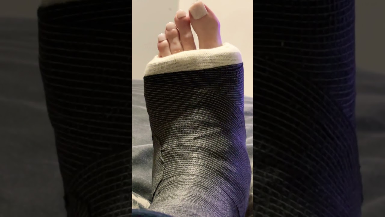 Short leg cast reused 