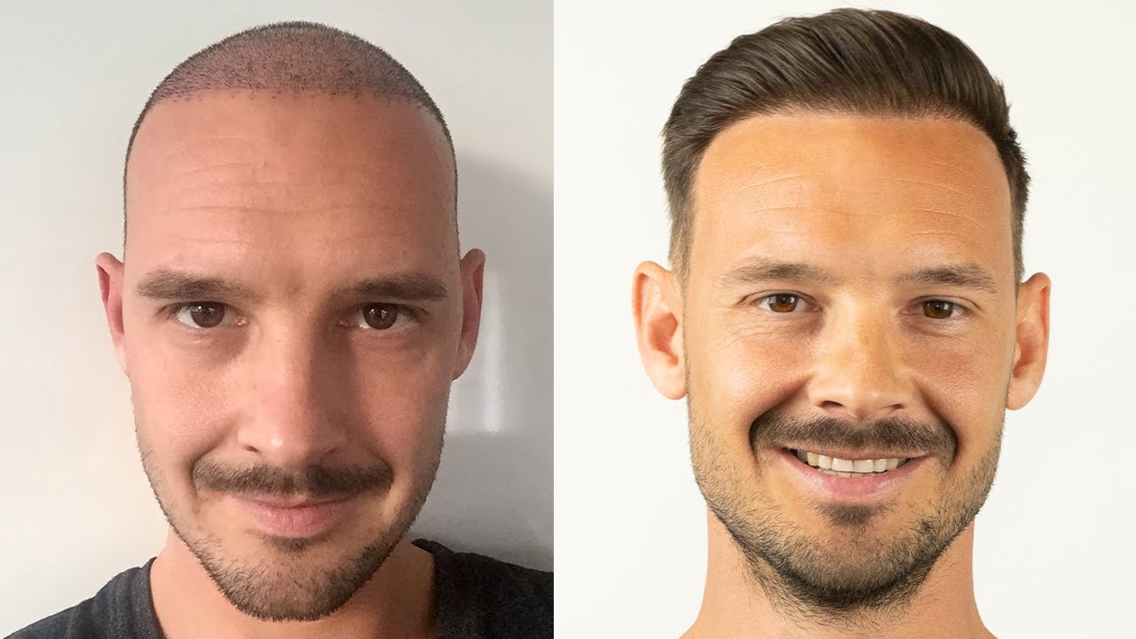 Haartransplantation Verlauf - Alle Vorher Nachher Bilder