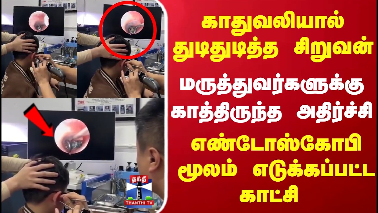 Screw | காதுவலியால் துடிதுடித்த சிறுவன்.. மருத்துவர்களுக்கு காத்திருந்த அதிர்ச்சி..