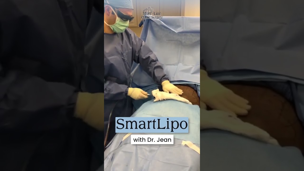 SmartLipo With Dr. Jean #Smartlipo