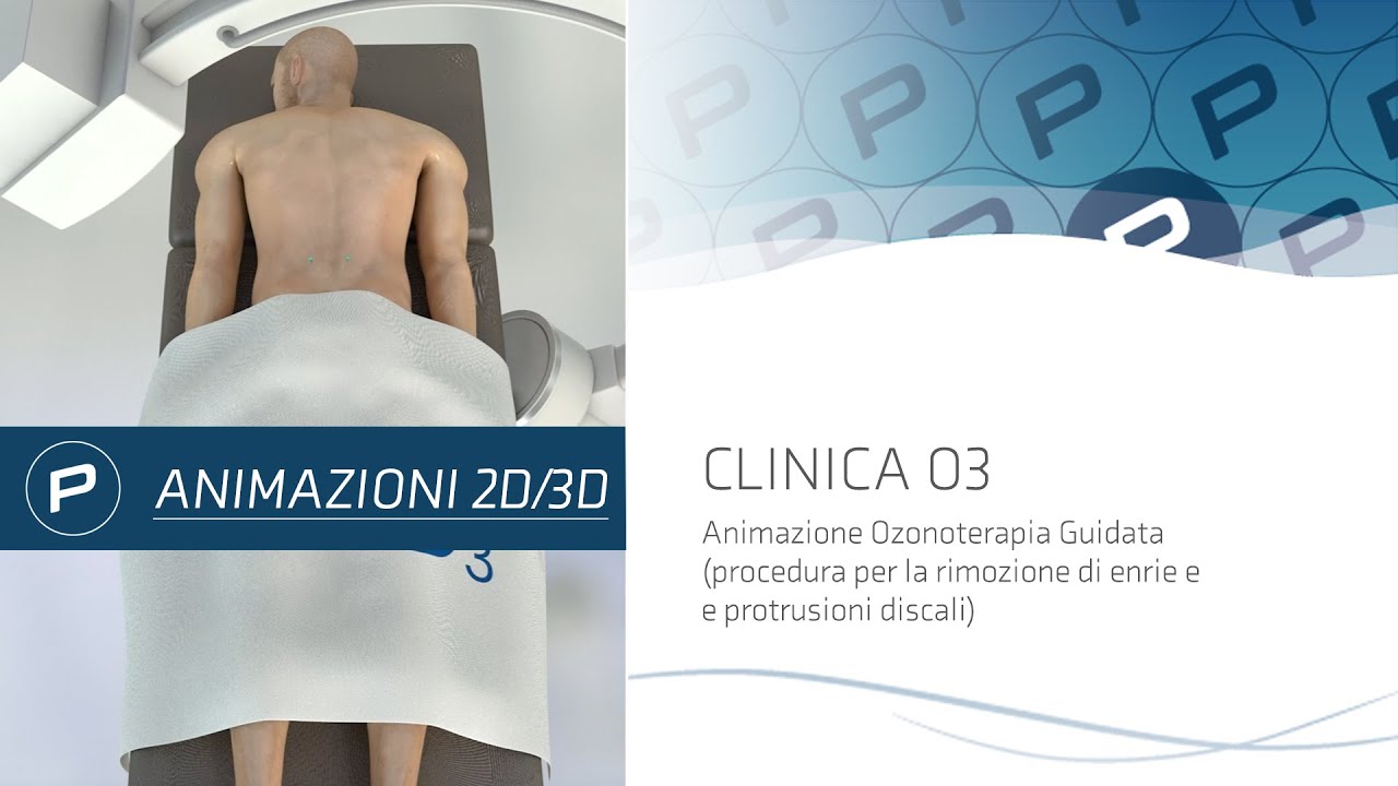 Clinica O3 - Animazione 3D per procedura di Ozonoterapia Guidata