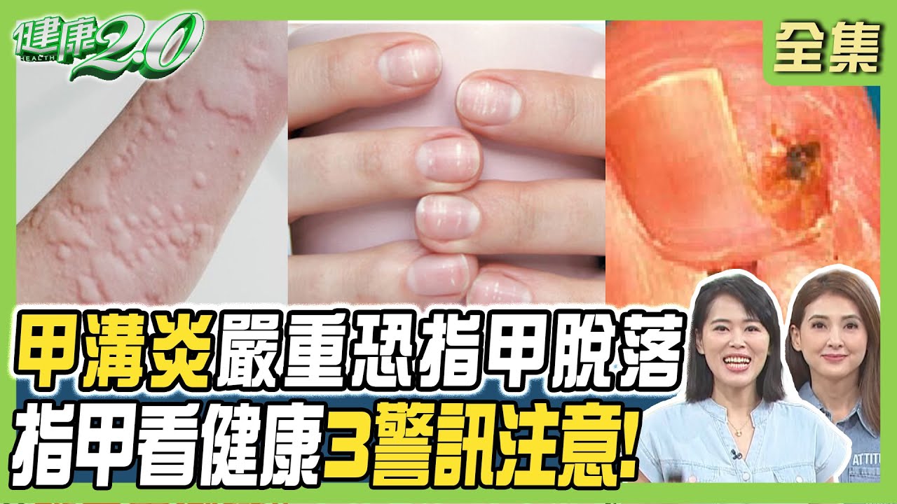 賈靜雯患甲溝炎竟長膿 嚴重恐指甲脫落!小指甲藏健康 有裂痕.橫紋.黑線要當心! 健康2.0 20240915【完整版】陳欣湄 韋汝 吳吉妮 蔡逸姍 趙函穎 陳潮宗 陸巧因  @tvbshealth20