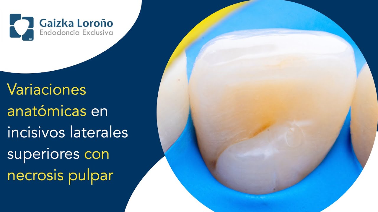 Variaciones anatómicas en incisivos laterales superiores con necrosis pulpar