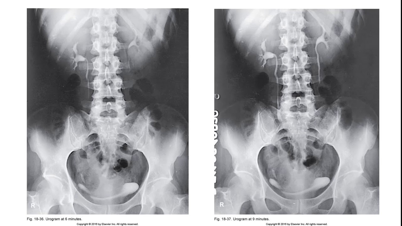 Intravenous Urography