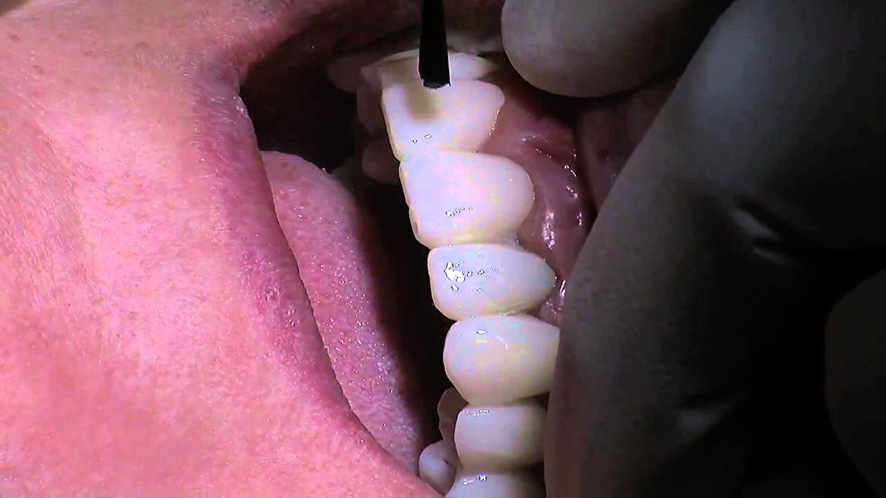 Smile make over with Dr  Parmar  Episode 11  glazing temporaries