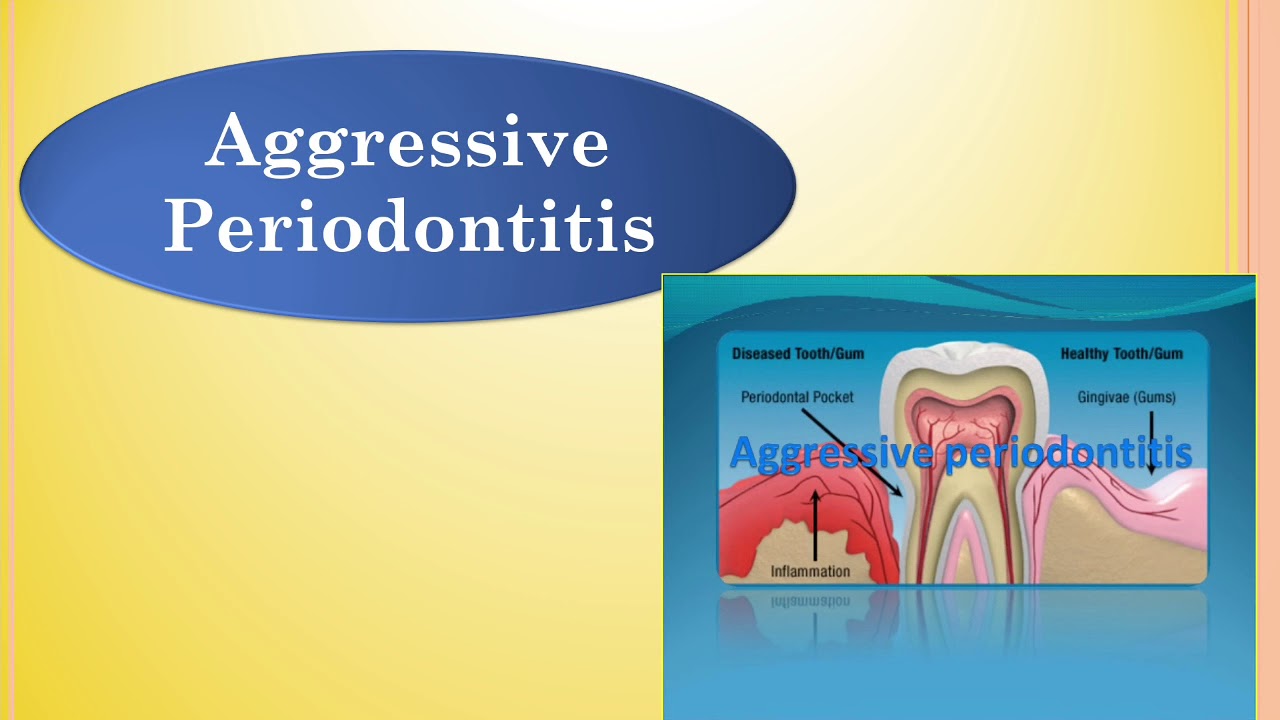Periodontitis II