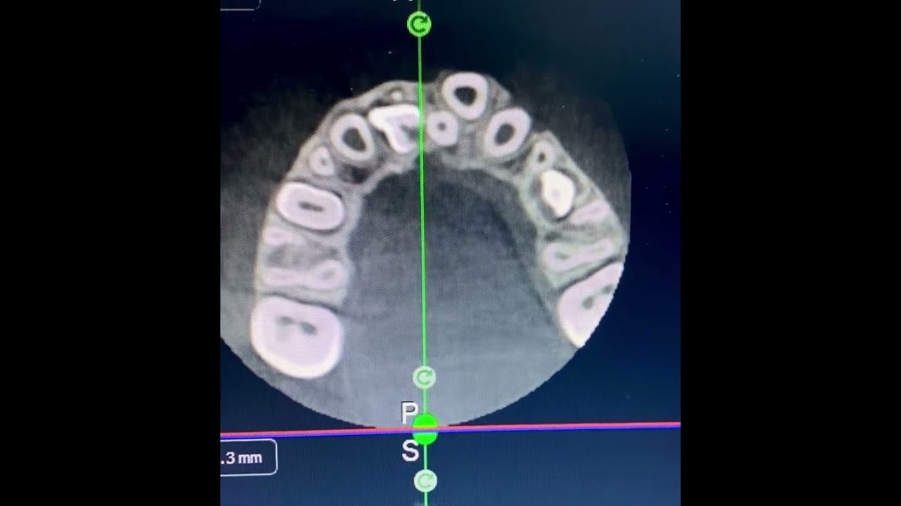 Maxillary supernumerary teeth, CBCT coronal section