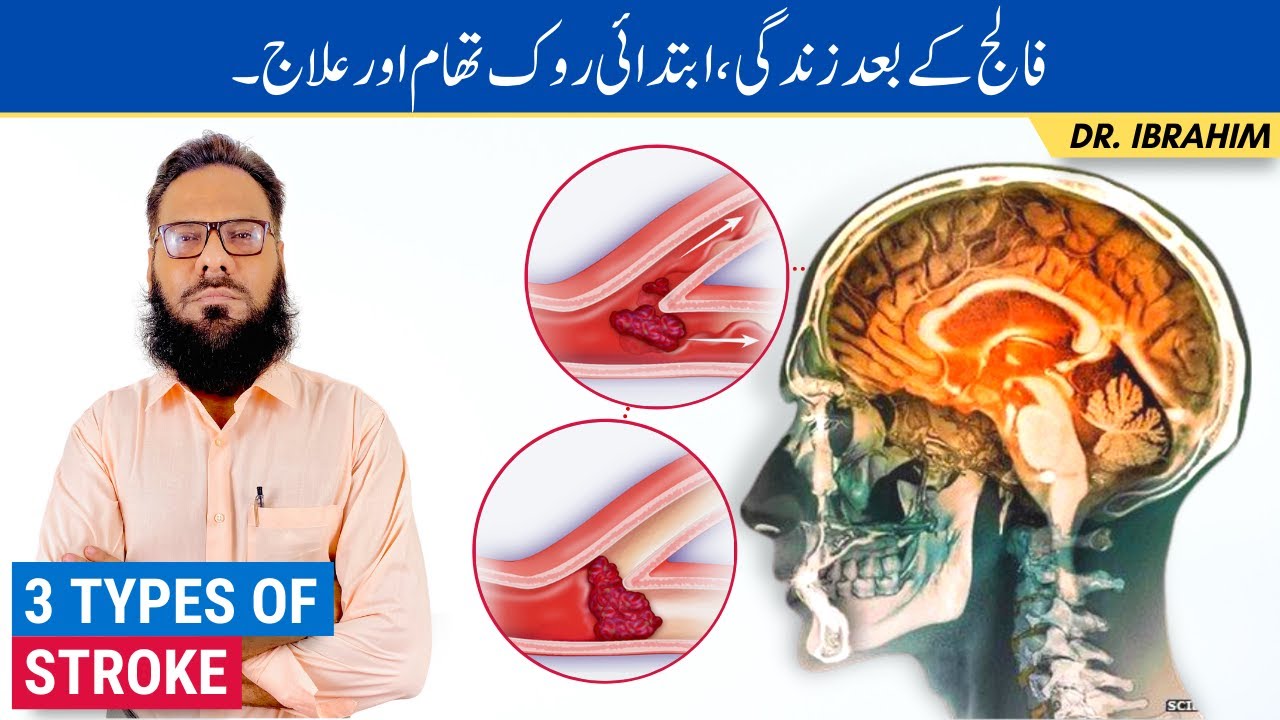 Three Types Of Stroke - Falij Ka Ilaj - Effective Treatment For Stroke/Paralysis - Urdu/Hindi