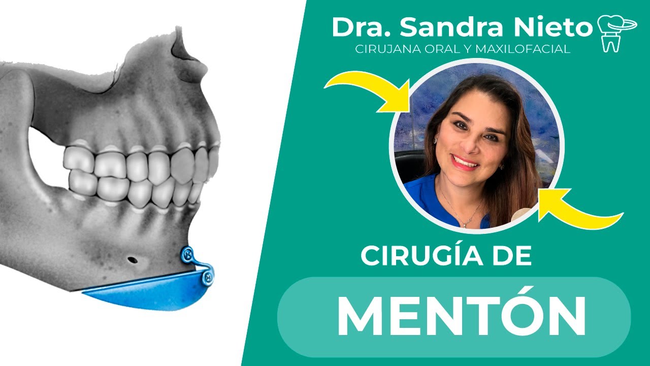 Todo sobre la Mentoplastía o Cirugía de Mentón😊✅