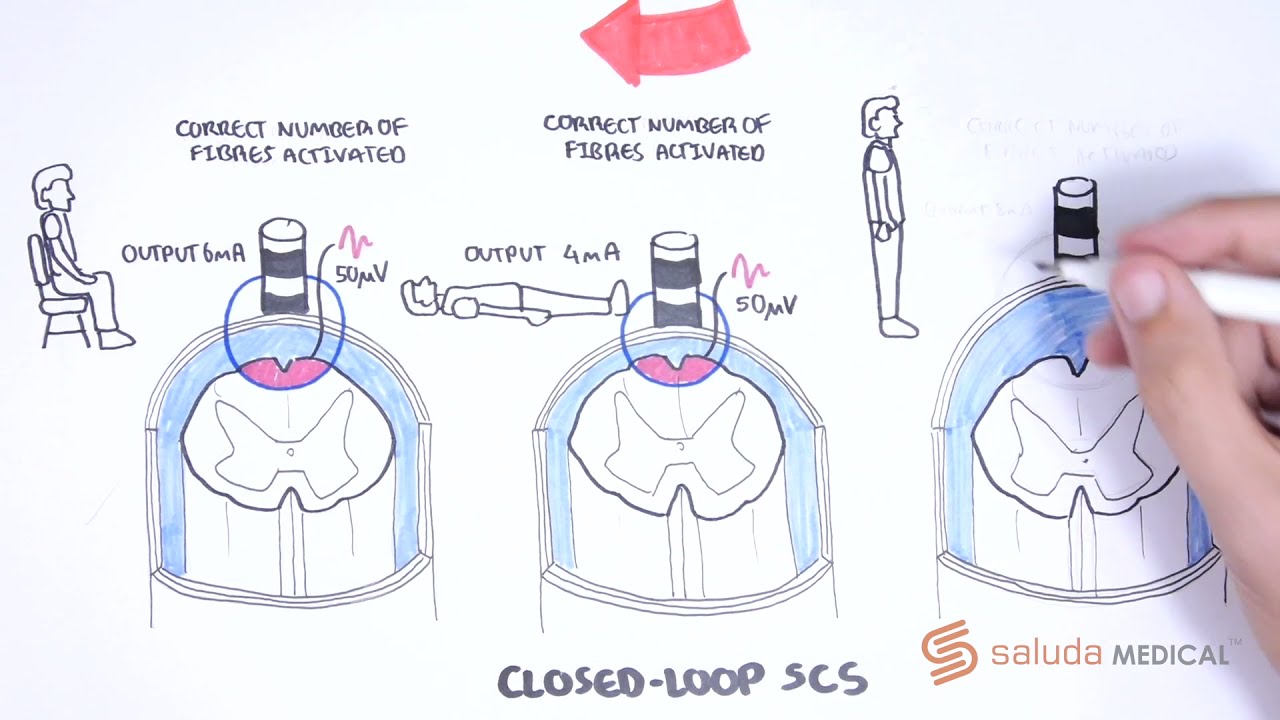 How Closed-Loop SCS Works (Part 2)