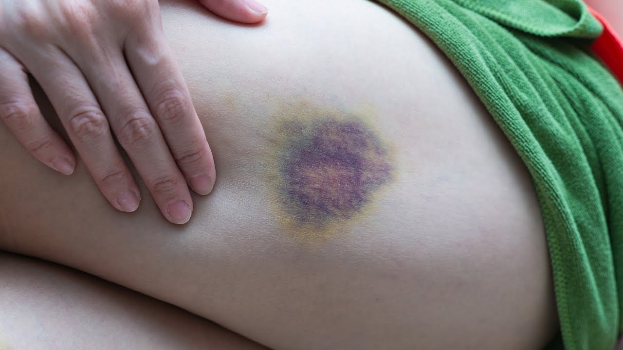 Dekubitusrisiko: Pflegerische Maßnahmen nach Expertenstandard erklärt   @DiePflegeexpertin
