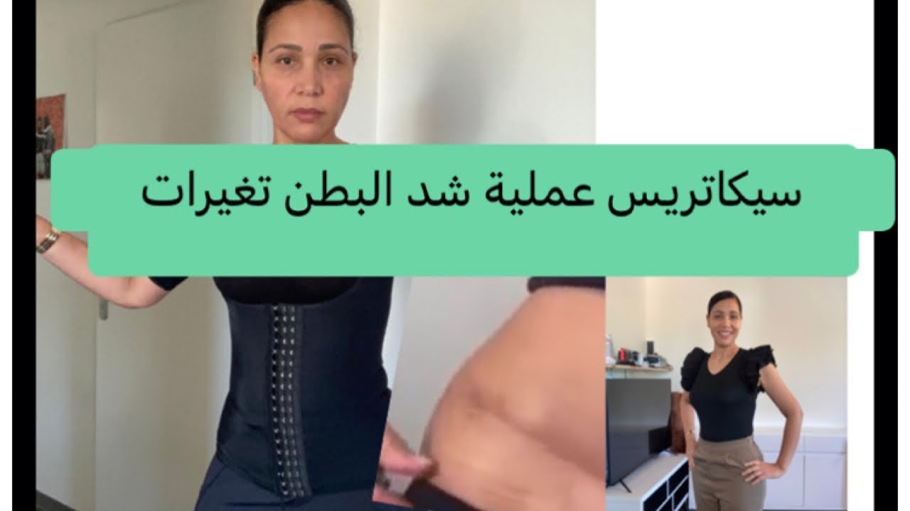 سيكاتريس عملية شد البطن بعد عشرة اشهر تغيرات