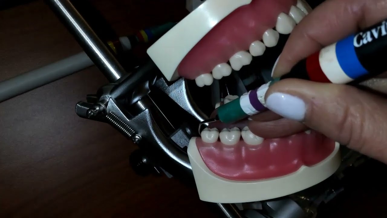 Ultrasonic tip adaptation for distal of the last molar