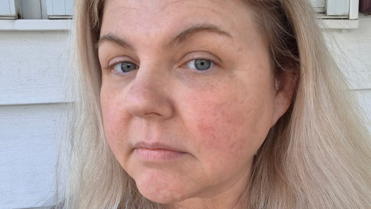 Unveiling my face after starting the chemotherapy cream, Kefunova, three weeks ago. 