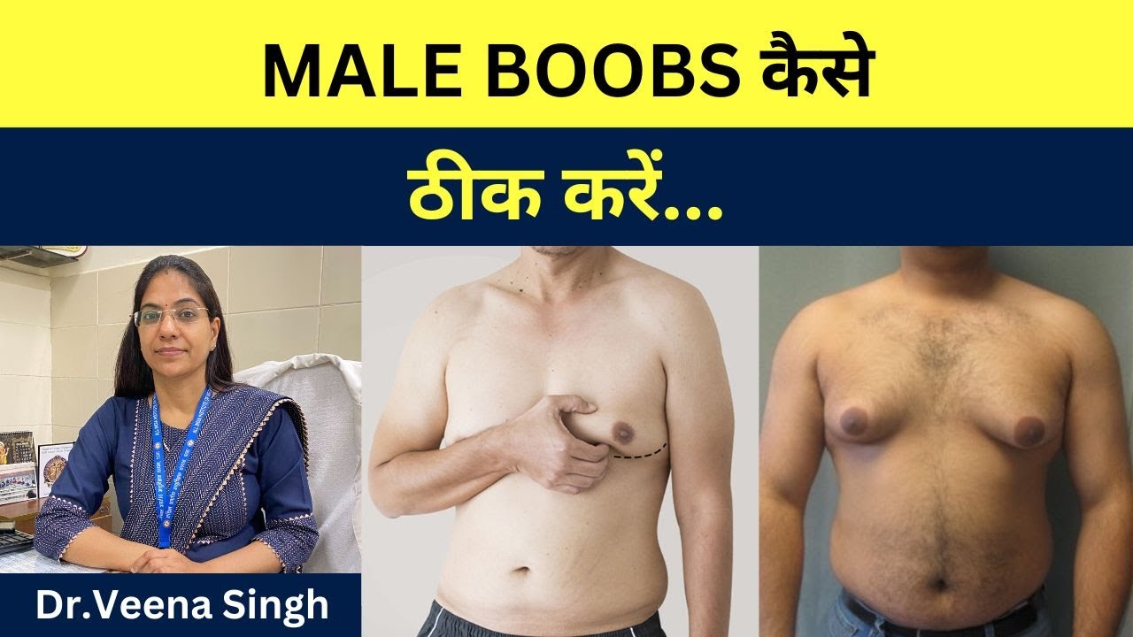 MALE BOOBS कैसे ठीक करें।।gynecomastia।।chest fat।।male breasts।। Dr Veena Singh।। #medicalmike