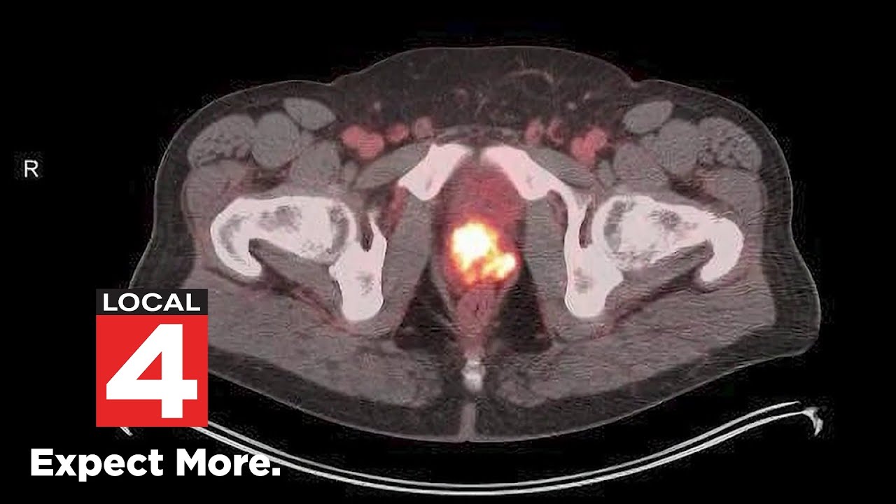 New imaging tool changes how doctors look for prostate cancer