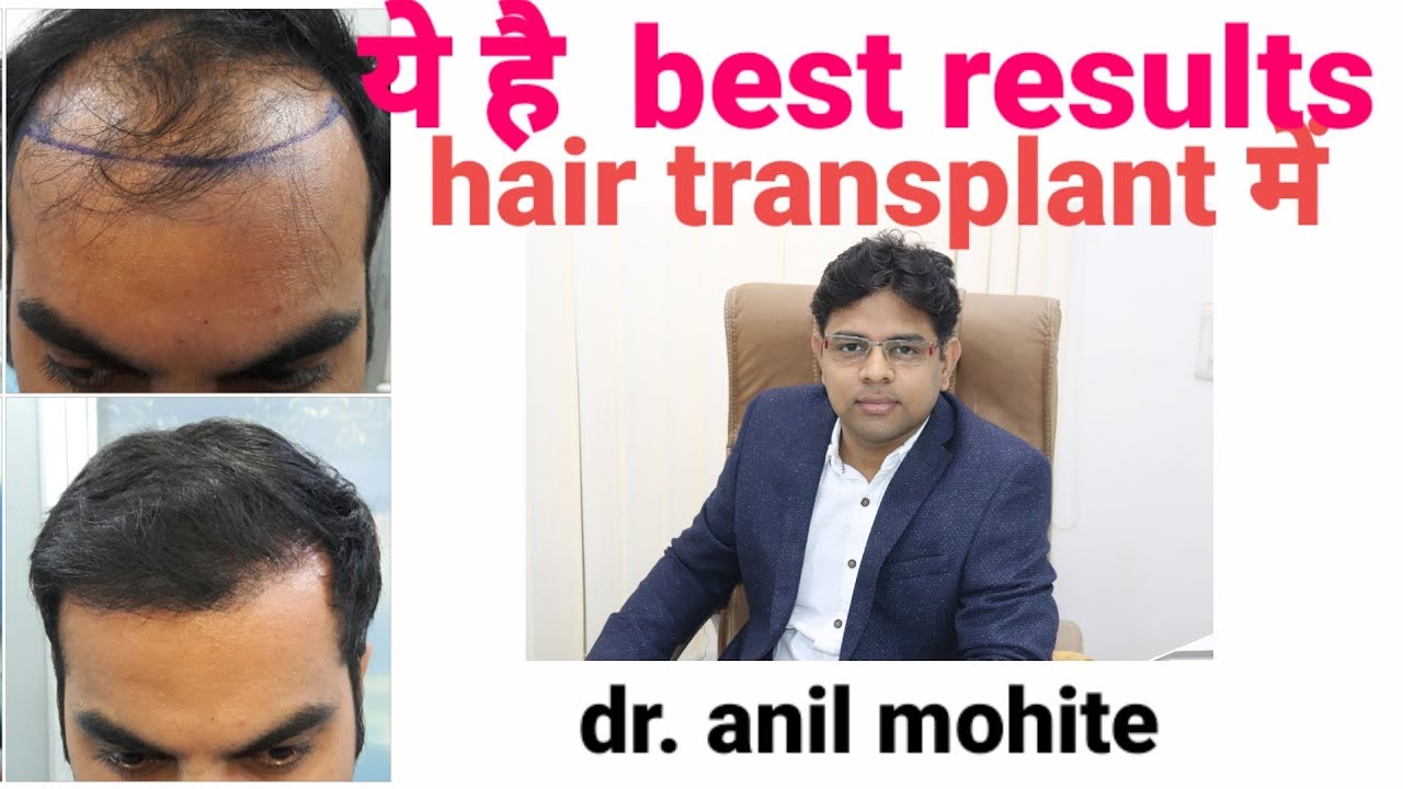 Hair transplant me best results l गंजेपन का इलाज l Bhopal l Dr Anil Mohite