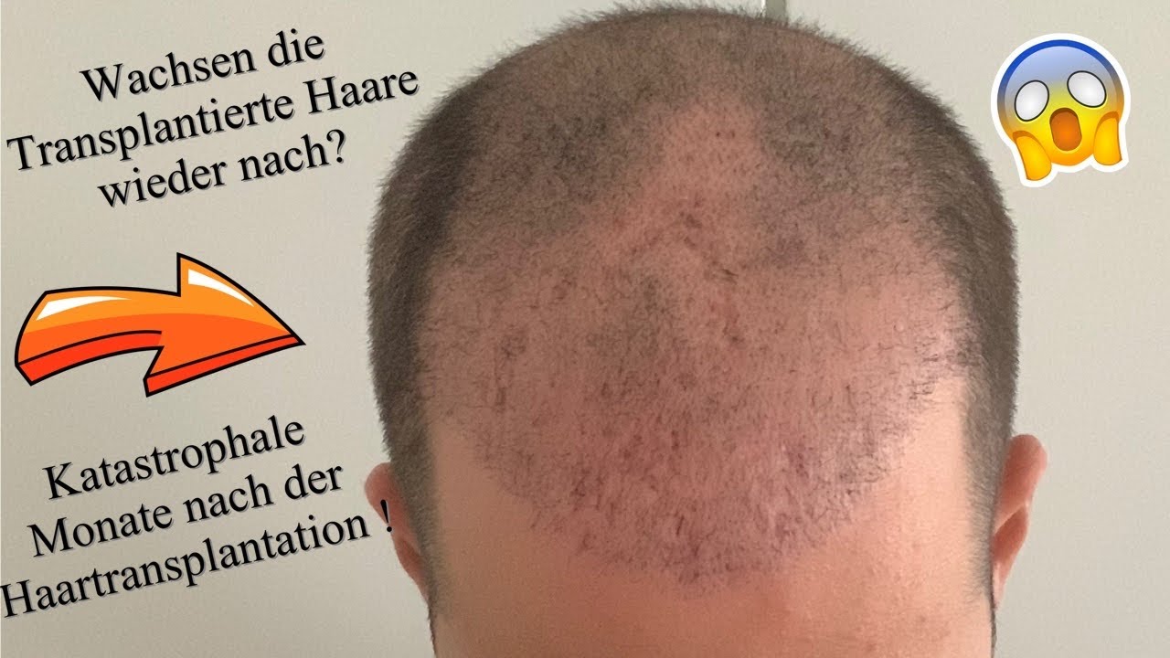 Haartransplantation Erfahrung - Transplantierte Haare sind wieder ausgefallen was nun?