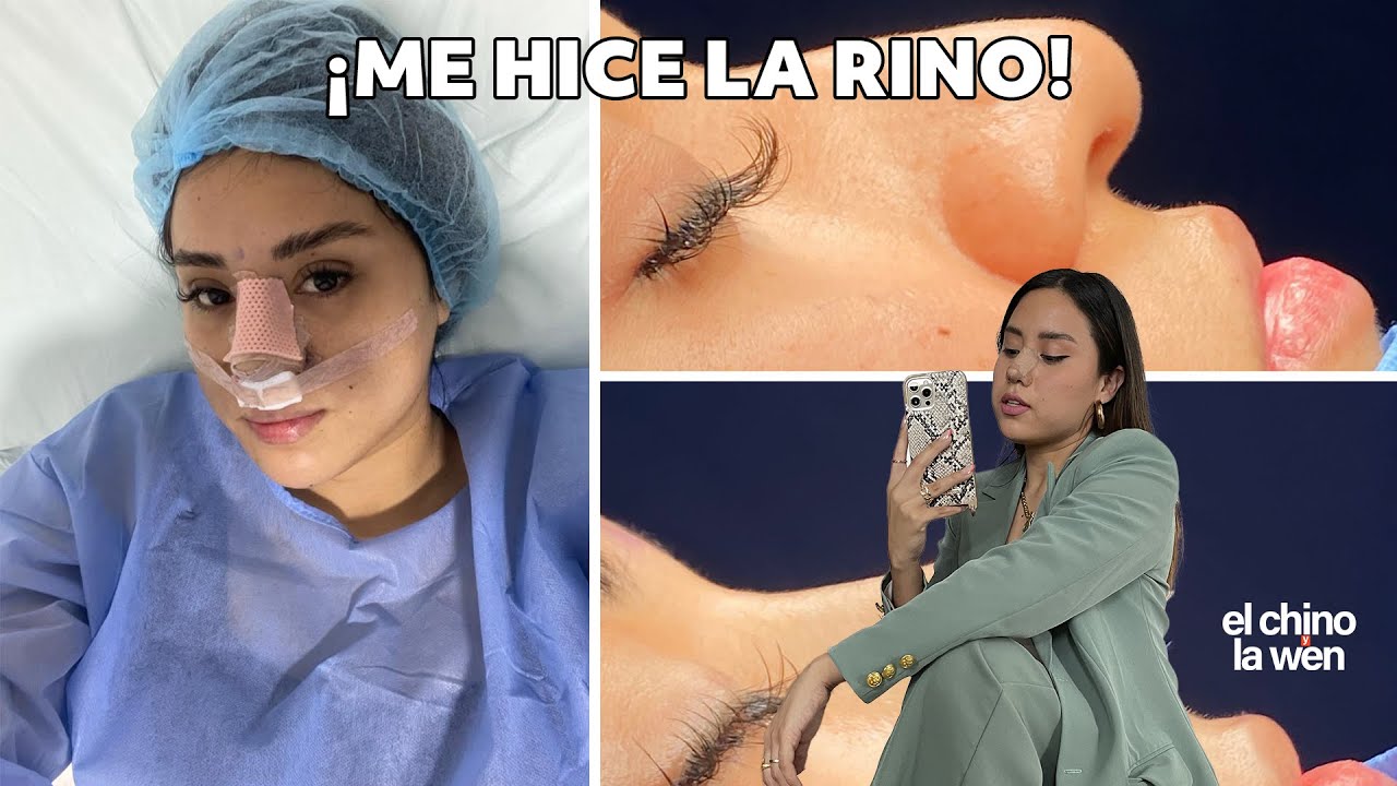 VLOG: ¡ME HICE LA RINO! Mi experiencia con la rinoplastia | la wen (2021)