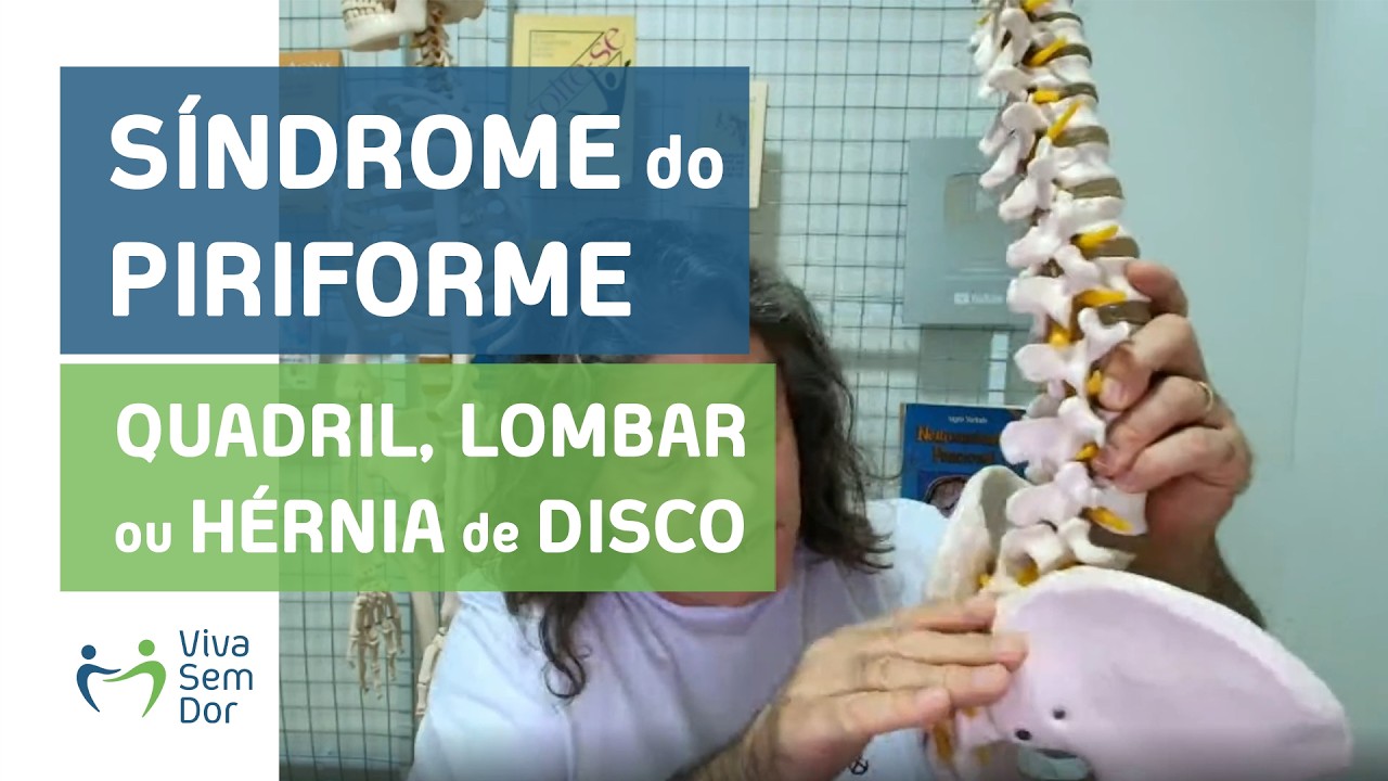 Síndrome do piriforme e a relação entre força no quadril e hérnia de disco