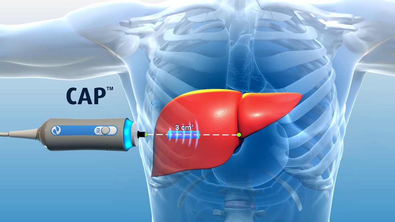 A patient's introduction to FibroScan | Ohio State Medical Center