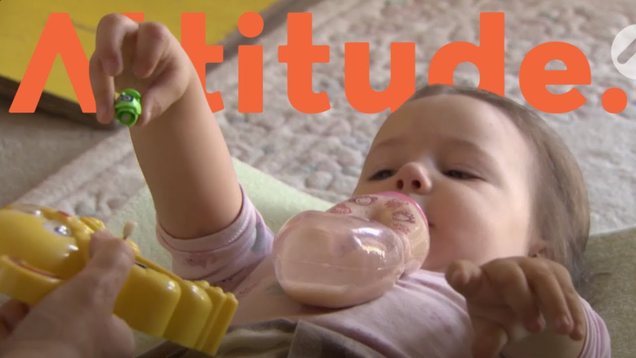 An Unusual Condition: Arthrogryposis