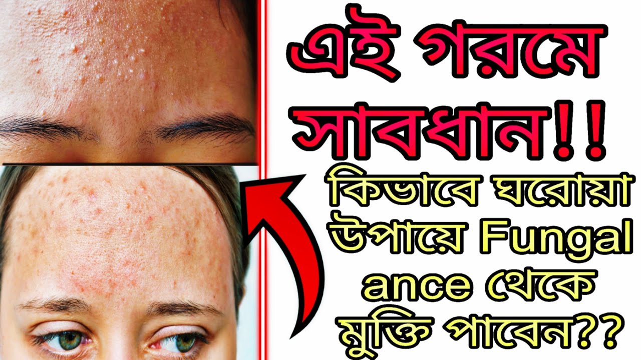 Fungal Ance কি? কেন হয়? কিভাবে দূর করবেন??Explore Trend And Vogue || #fungalacne