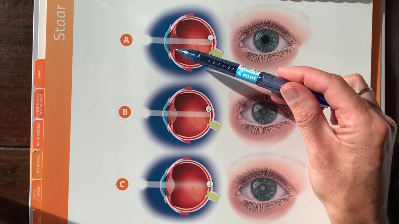 Hoe werkt een kunstlens in het oog na staaroperatie?