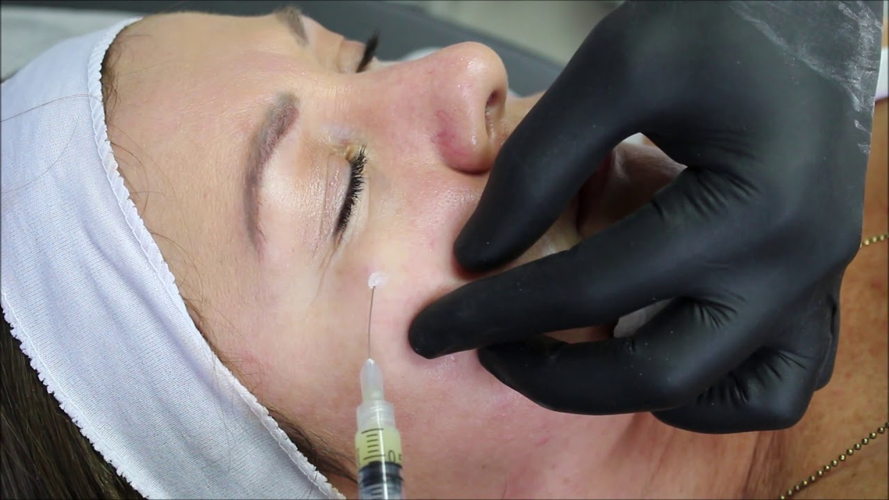 Plasma Gel / Plasma Rico en Plaquetas