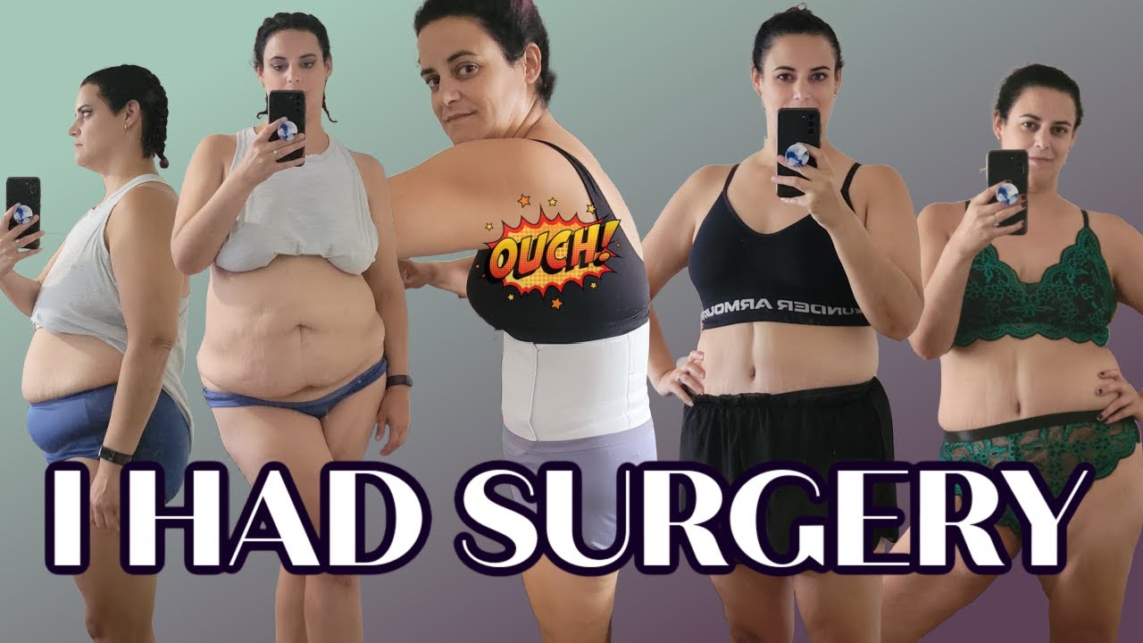 SURGERY UPDATE | breast reduction and panniculectomy | before & after