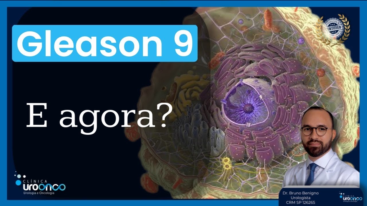 Minha Biópsia de Próstata veio Gleason 9 | E agora, qual a melhor estratégia a seguir?