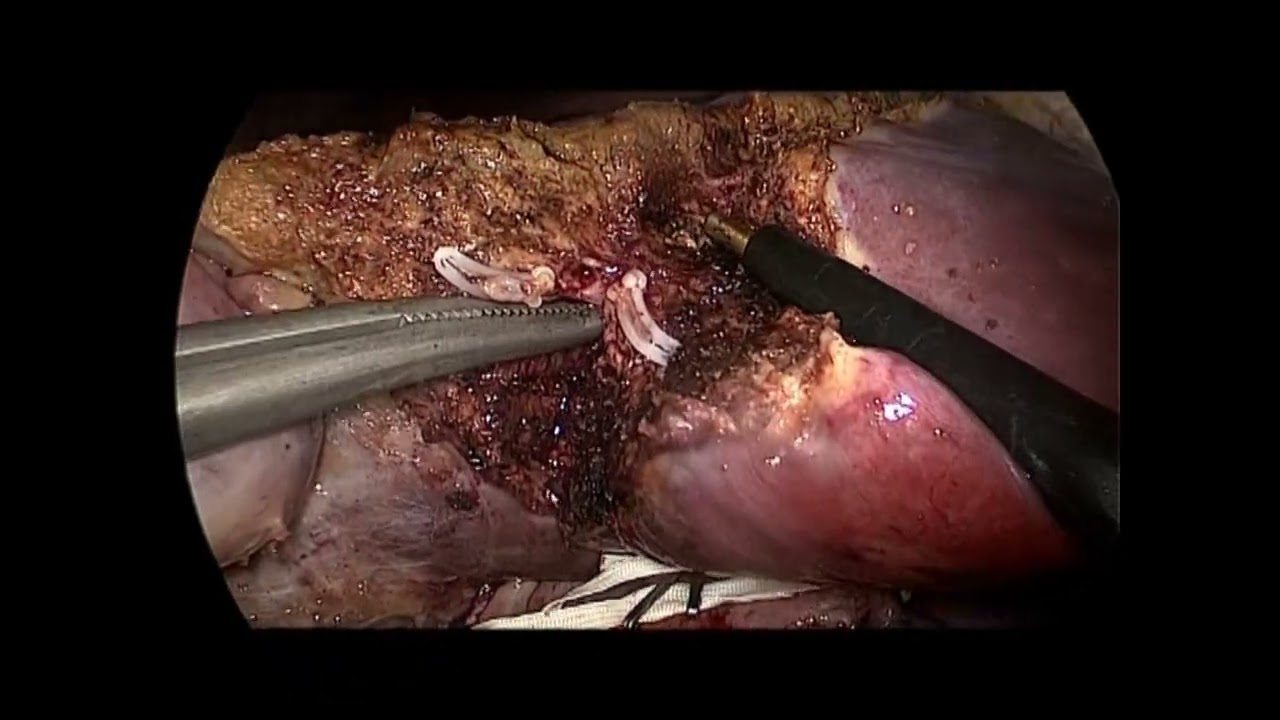 Soubrane-Left hepatectomy living donor