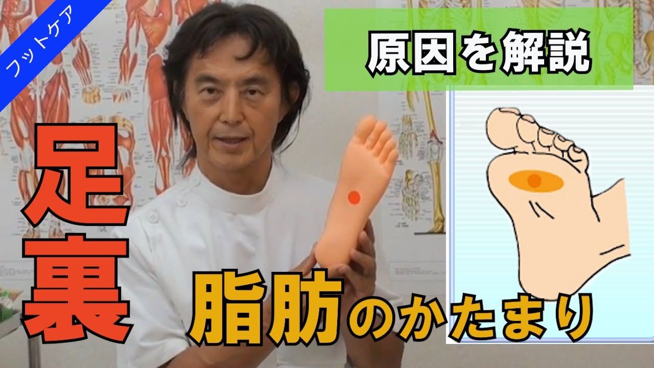【症状と原因】足裏の脂肪腫