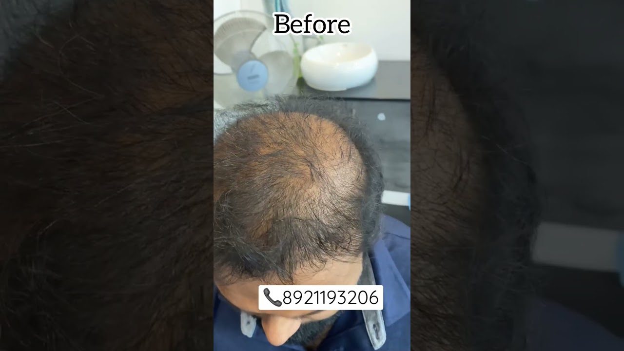 Scalp micropigmentation (SMP) for increasing hair density , MALA, Thrissur, kerala, 📞8921193206